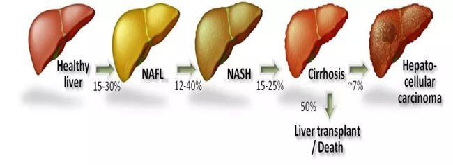 肝癌形成过程